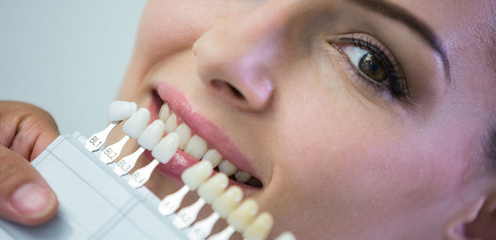 Faccette estetiche dentali:quando e perchè?